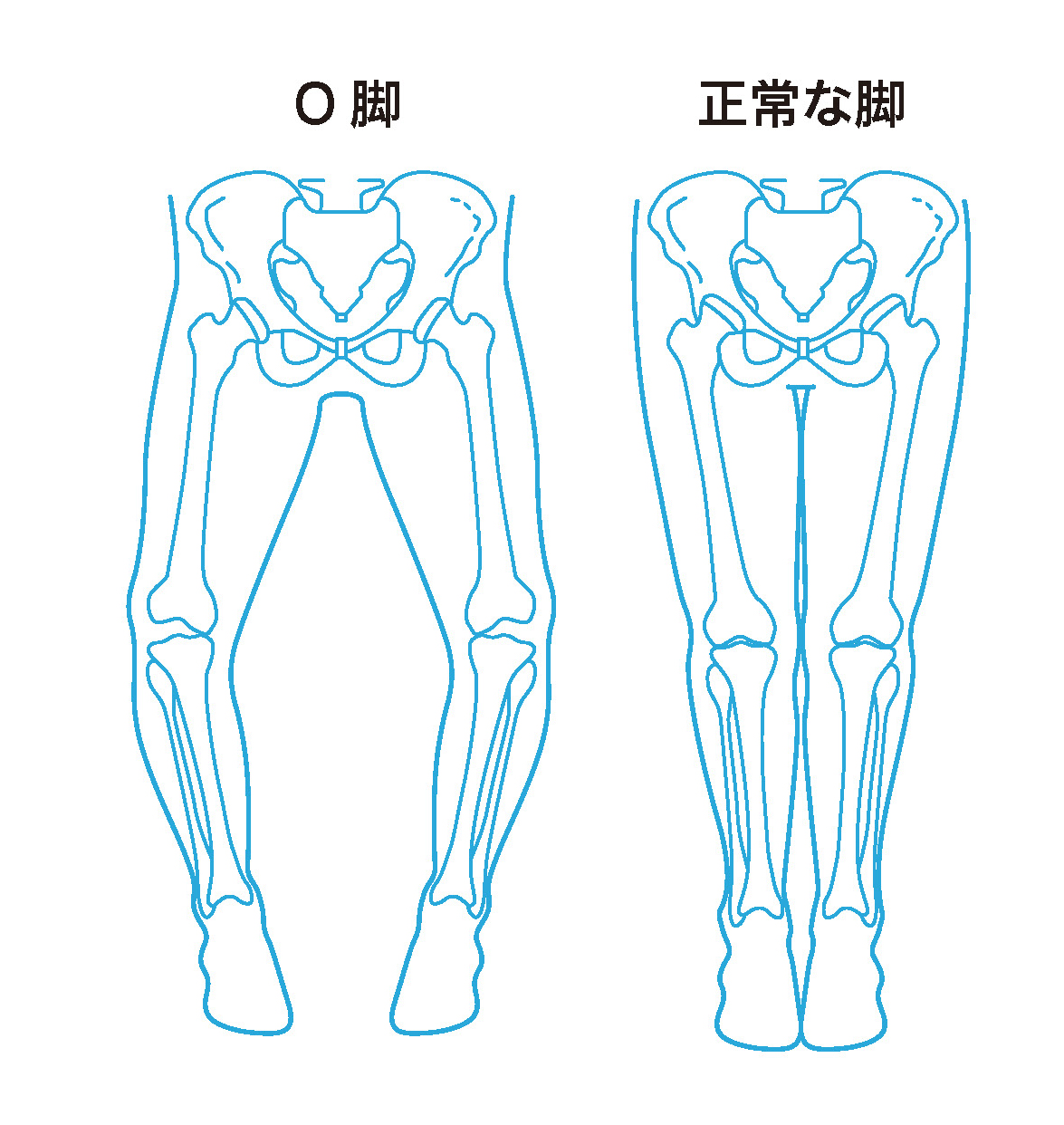 O脚と正常な脚