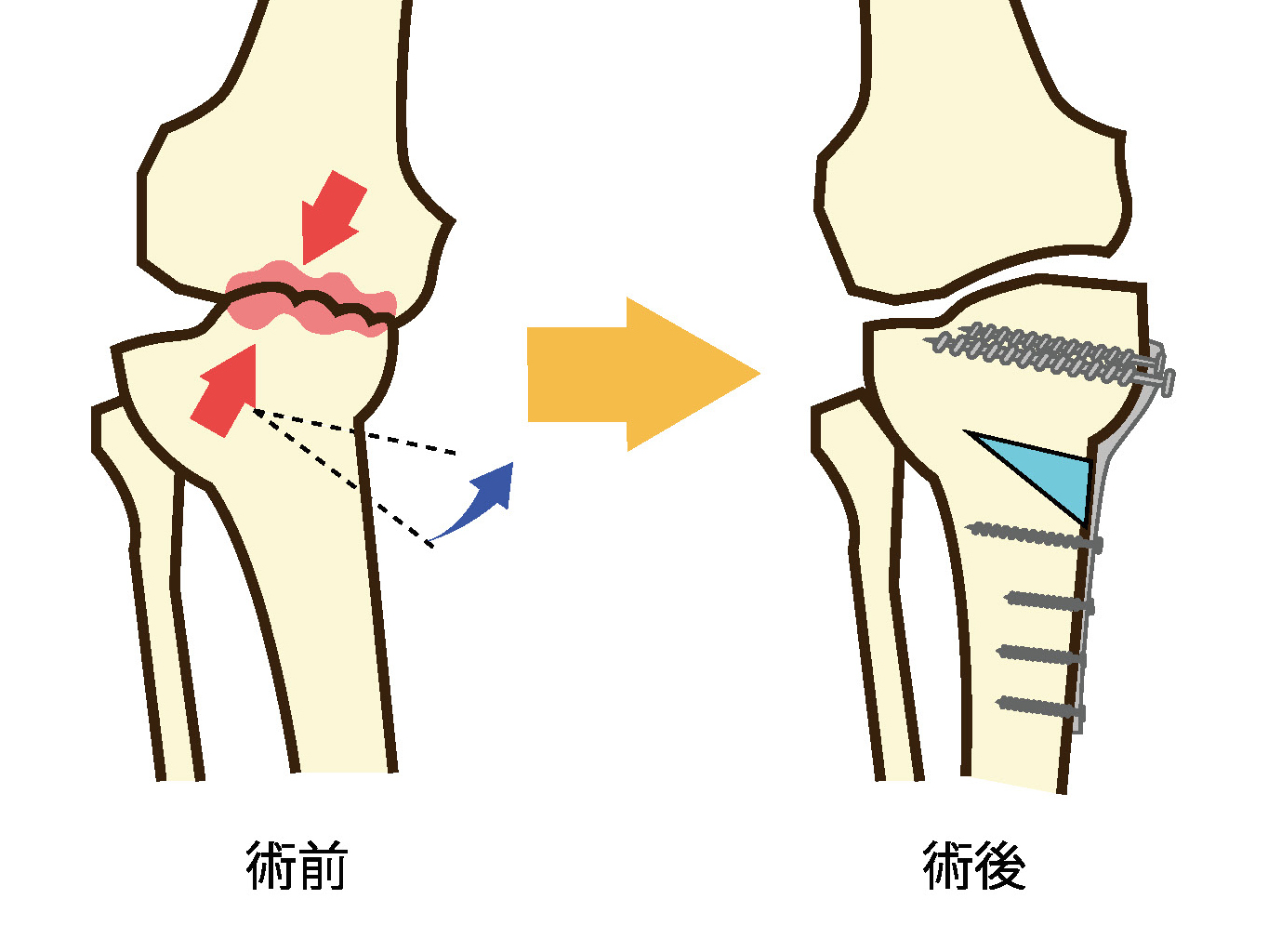 骨切り術