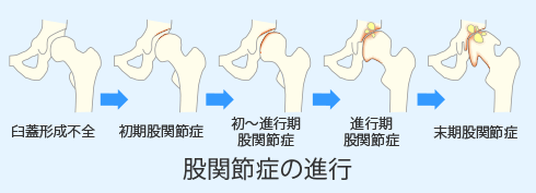 藤井 玄二 先生 股関節の疾患種類と受診の目安 第21回 高齢期を痛みと共に過ごすのはつらいもの 違和感は早めに相談を 人工関節ドットコム