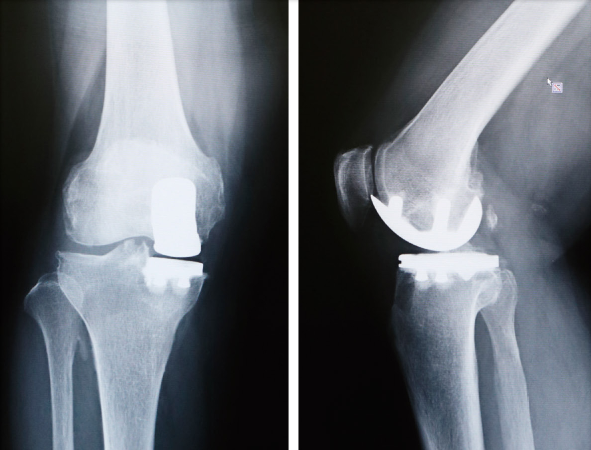 単顆型置換術後レントゲン（正面と側面）