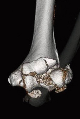 國府 幸洋 先生 人工肘関節置換術について 肘や手指の痛み 腫れは 関節リウマチと上肢の治療に精通した手外科専門医に相談を 人工関節ドットコム