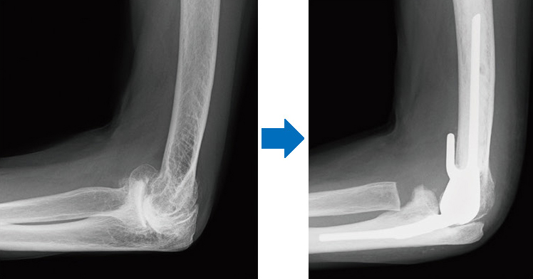 國府 幸洋 先生 人工肘関節置換術について 肘や手指の痛み 腫れは 関節リウマチと上肢の治療に精通した手外科専門医に相談を 人工関節ドットコム
