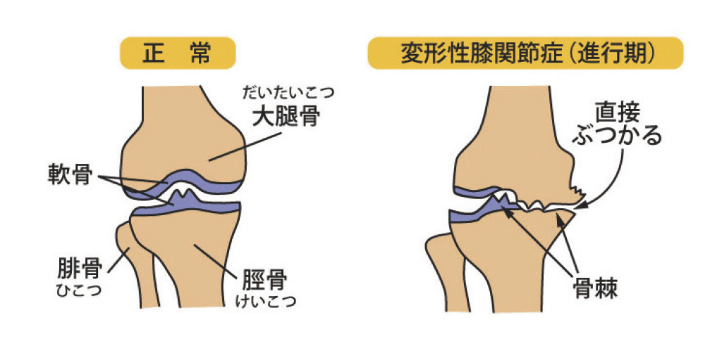 川上 公誠 先生 膝の痛みと変形性膝関節症 膝痛の治療 今後の人生を考えた納得のいく治療選択を 人工関節ドットコム