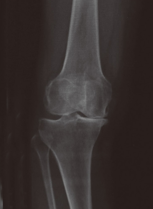 変形性膝関節症のレントゲン