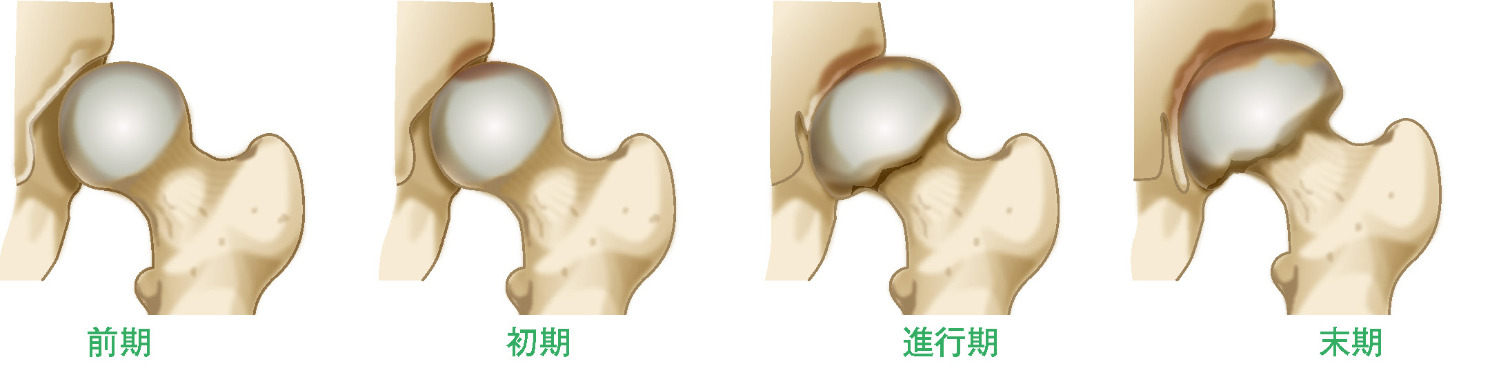 変形性股関節症の進行