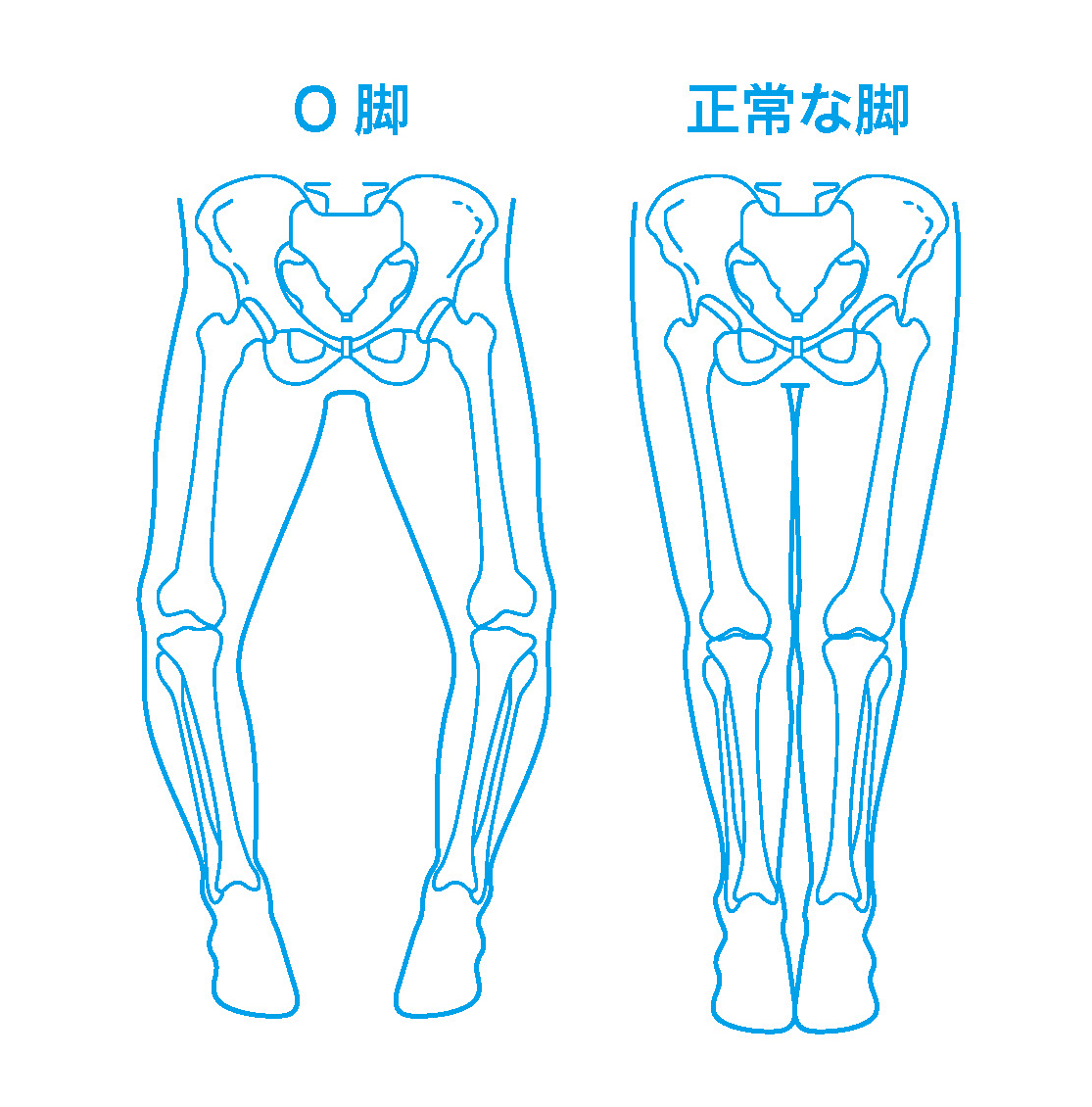 O脚と正常な脚のイラスト