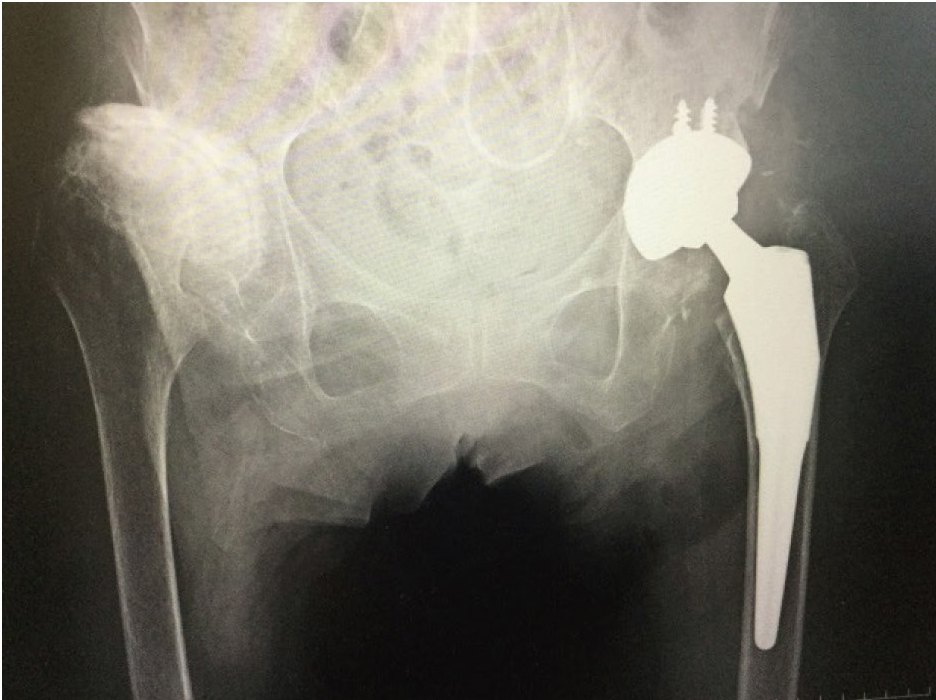 人工股関節置換術後のレントゲン