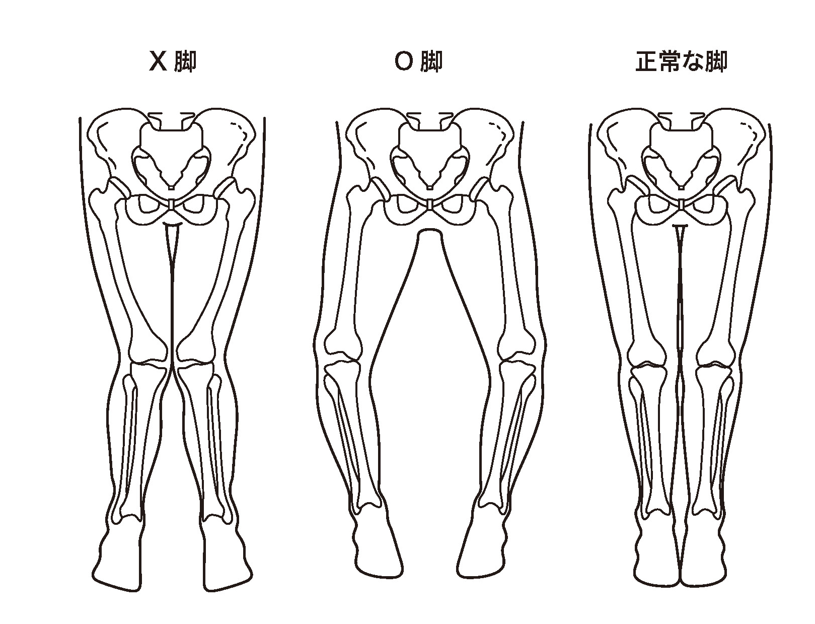 O脚、X脚、正常な脚のイラスト