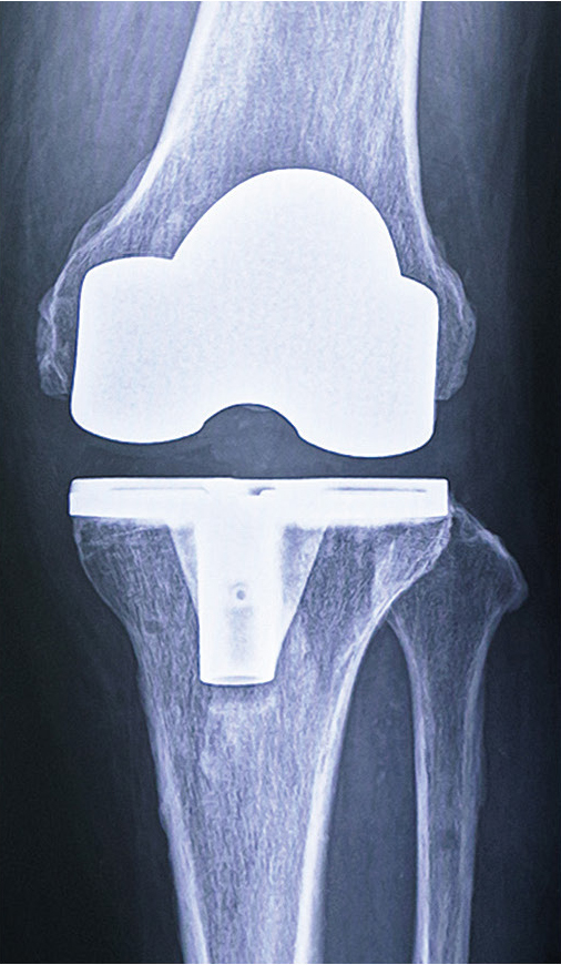 人工膝関節置換術後のレントゲン