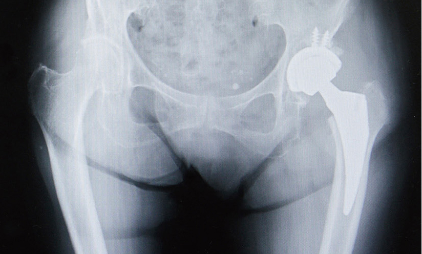 人工股関節置換術後のレントゲン