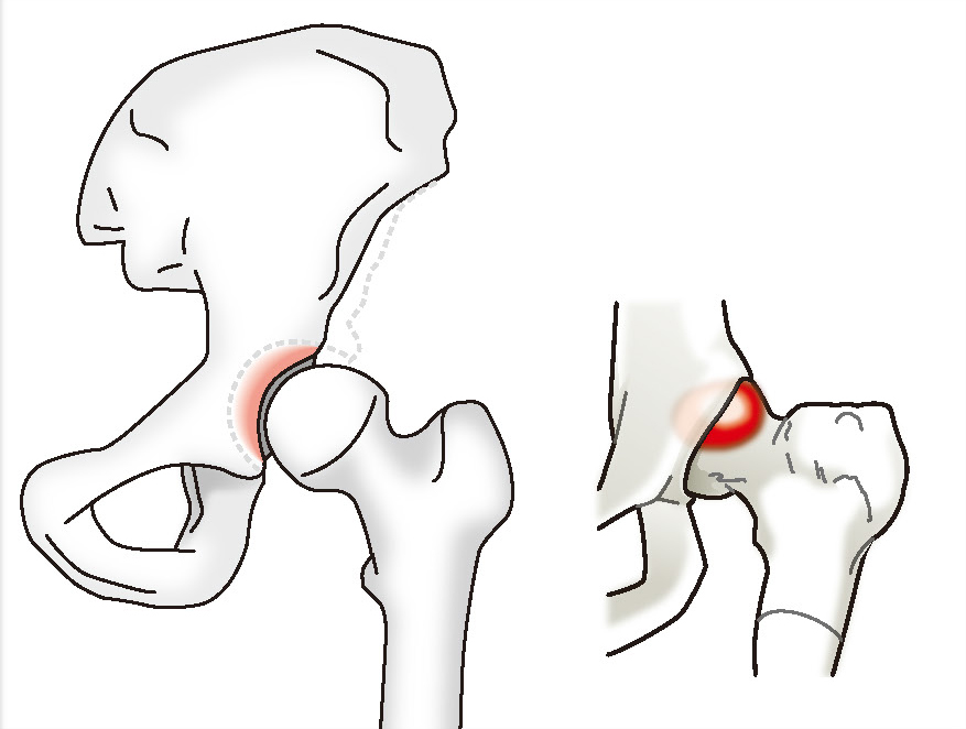 遠藤 裕介 先生 股関節の痛みの原因と治療法 第221回 股関節の痛み専門医に相談し自分の状態に適した治療 や生活のアドバイスを受けましょう 人工関節ドットコム