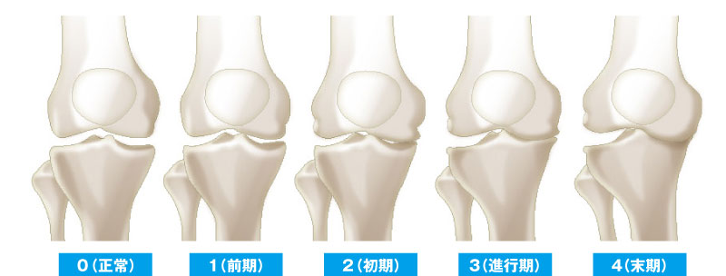 変形性膝関節症5段階