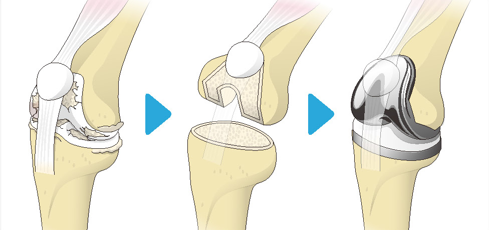 人工膝関節全置換術の流れ