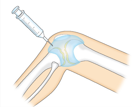 膝関節にはヒアルロン酸注射
