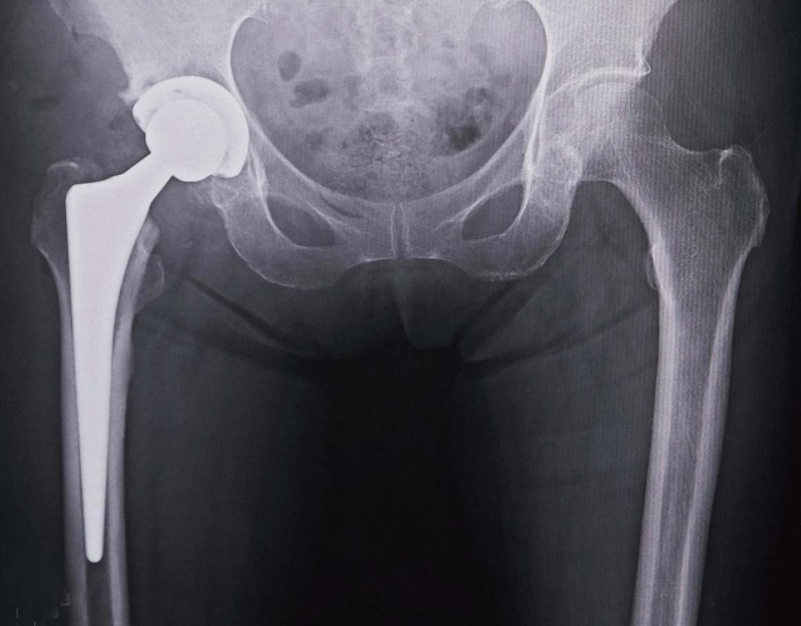 人工股関節置換術後のレントゲン