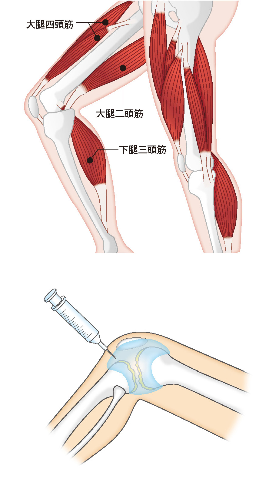 ヒアルロン酸注射