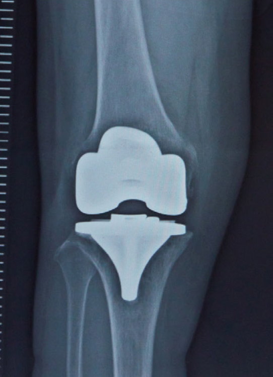 人工膝関節置換術後のレントゲン