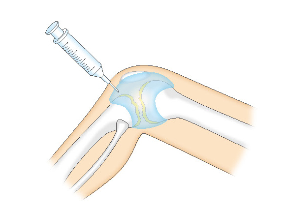 ヒアルロン酸の関節内注射