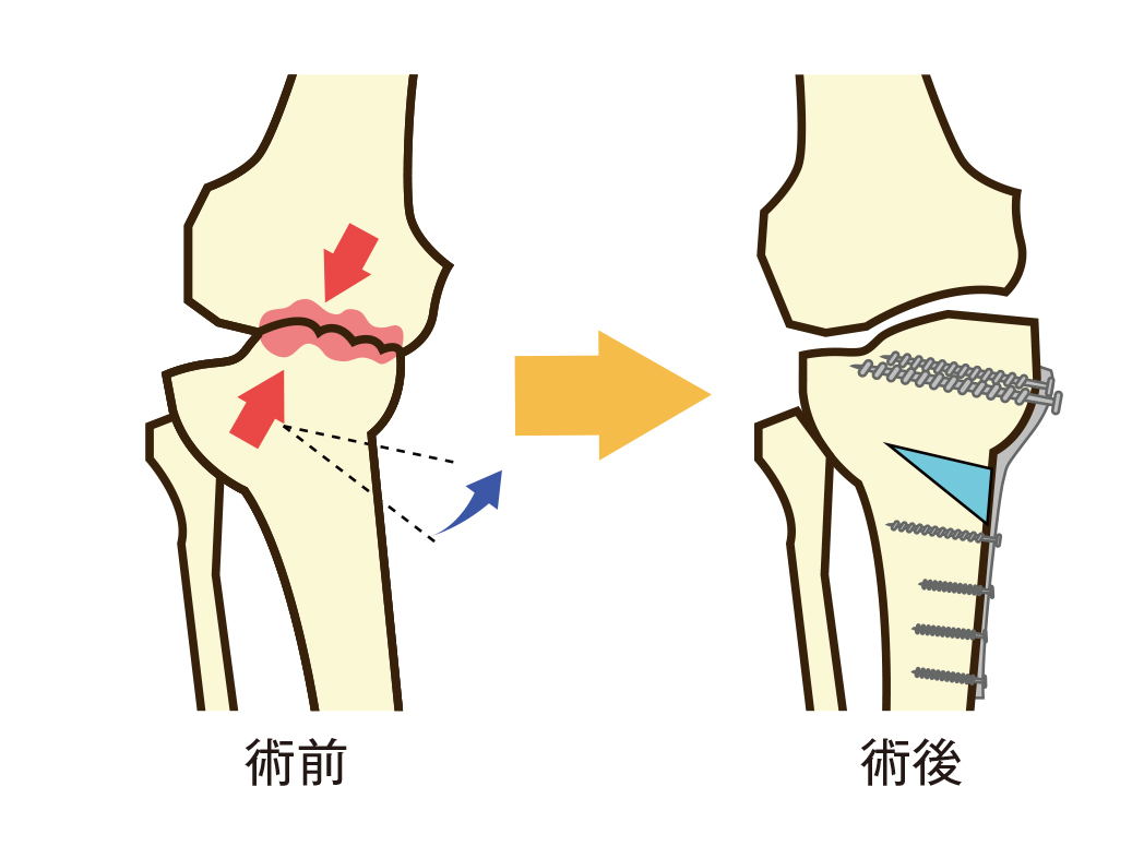 骨切り術