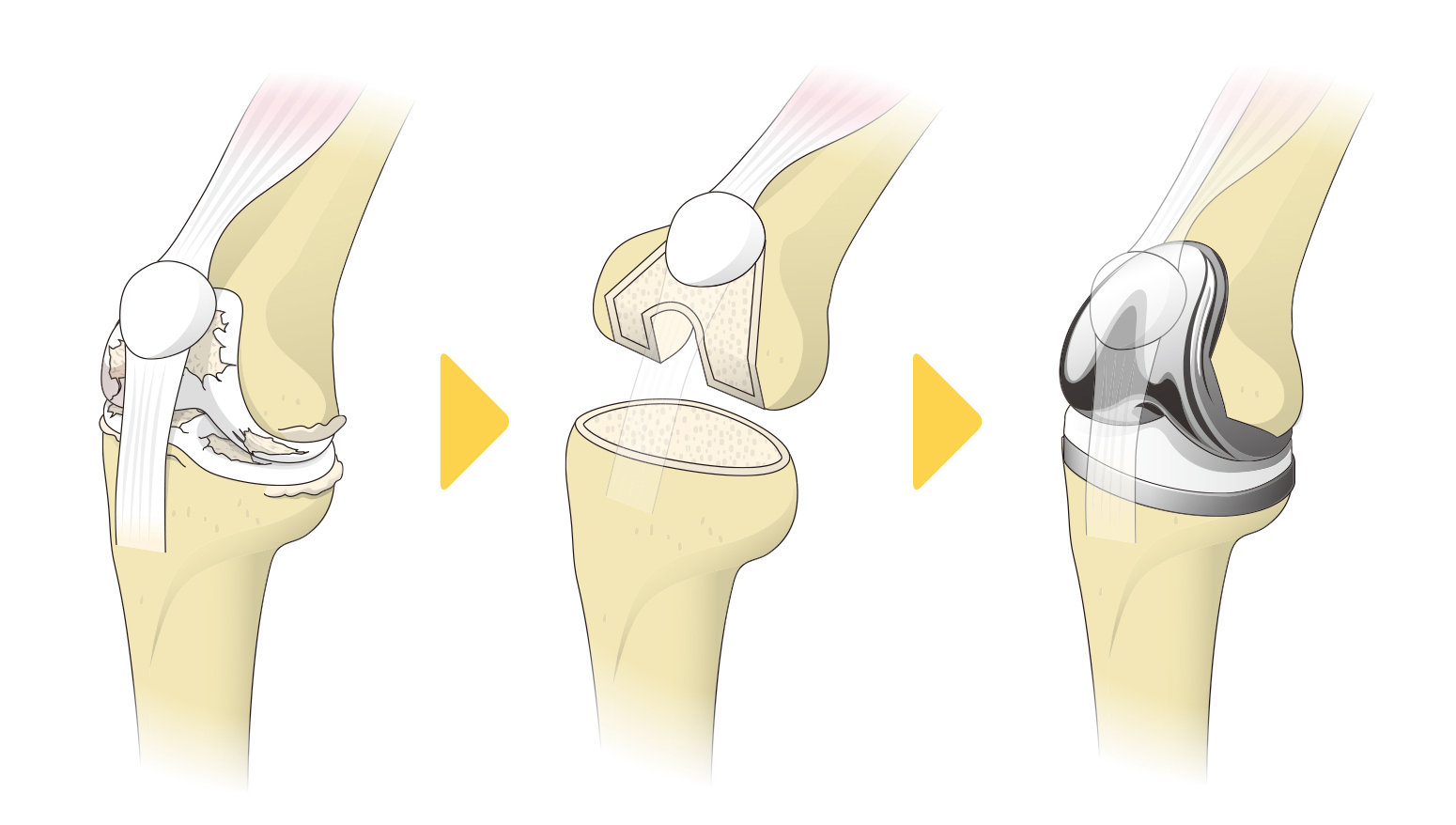 人工膝関節全置換術の流れ