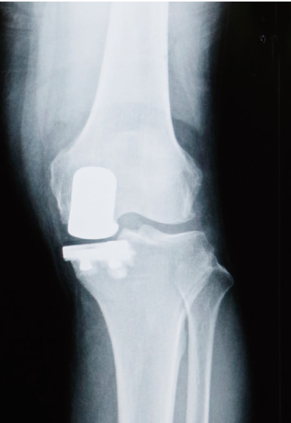 人工膝関節部分置換術後のレントゲン