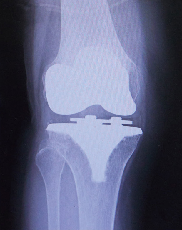 人工膝関節全置換術後のレントゲン