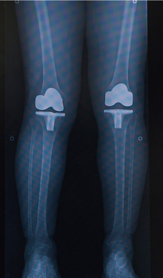 アライメントを配慮した置換術後のレントゲン