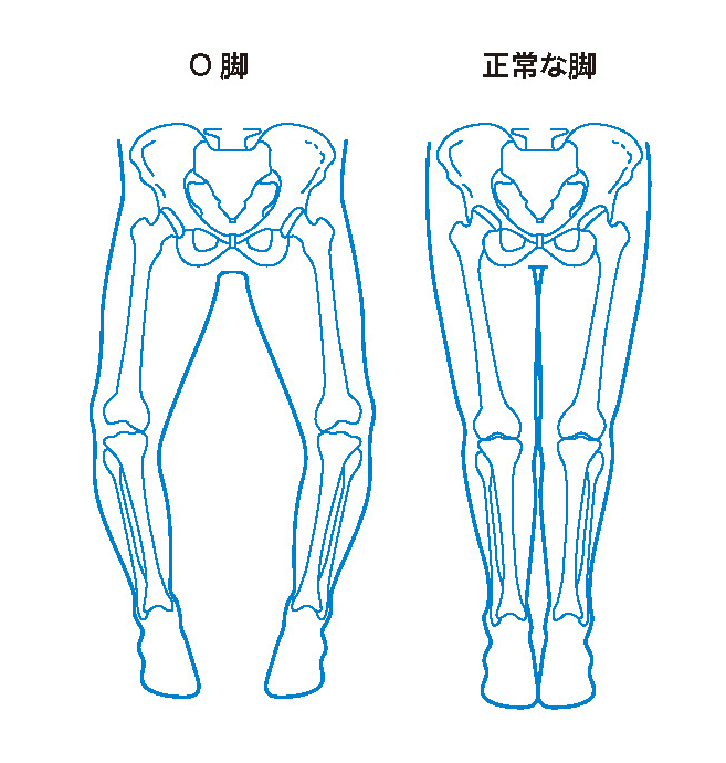 寺島 照雄 先生 日本人に圧倒的に多いo脚と膝の痛み 第236回 膝の痛みや変形をあきらめず自分に合った治療で活動的な毎日を 人工関節ドットコム