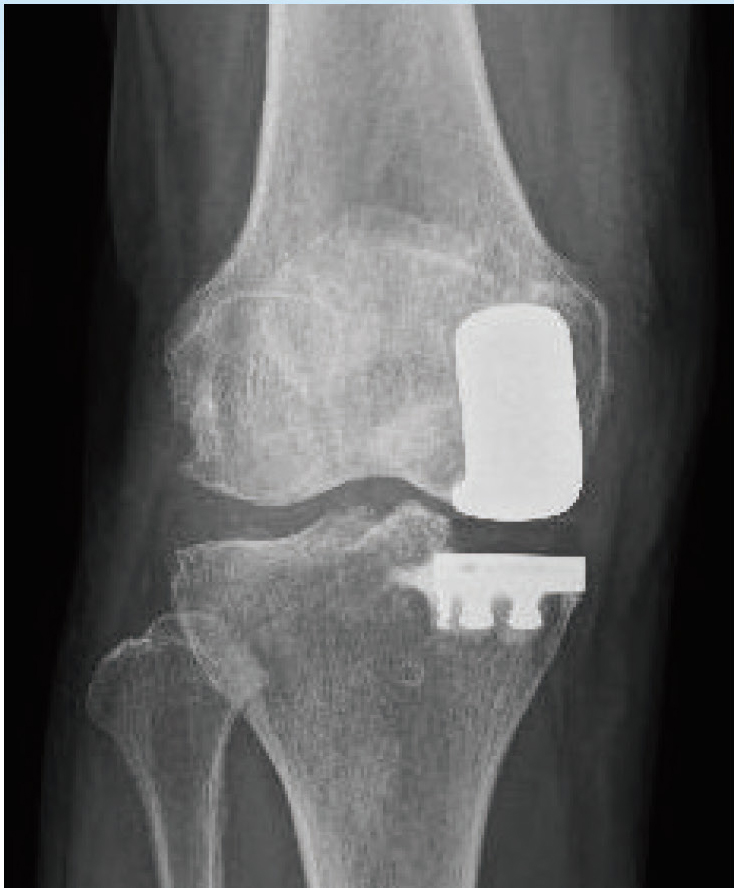 部分置換術後のレントゲン