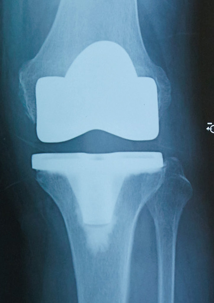 人工膝関節置換術後のレントゲン