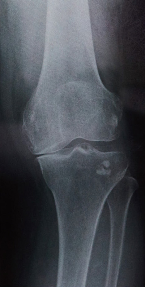 変形性膝関節症のレントゲン