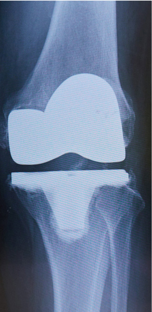 人工膝関節全置換術後のレントゲン