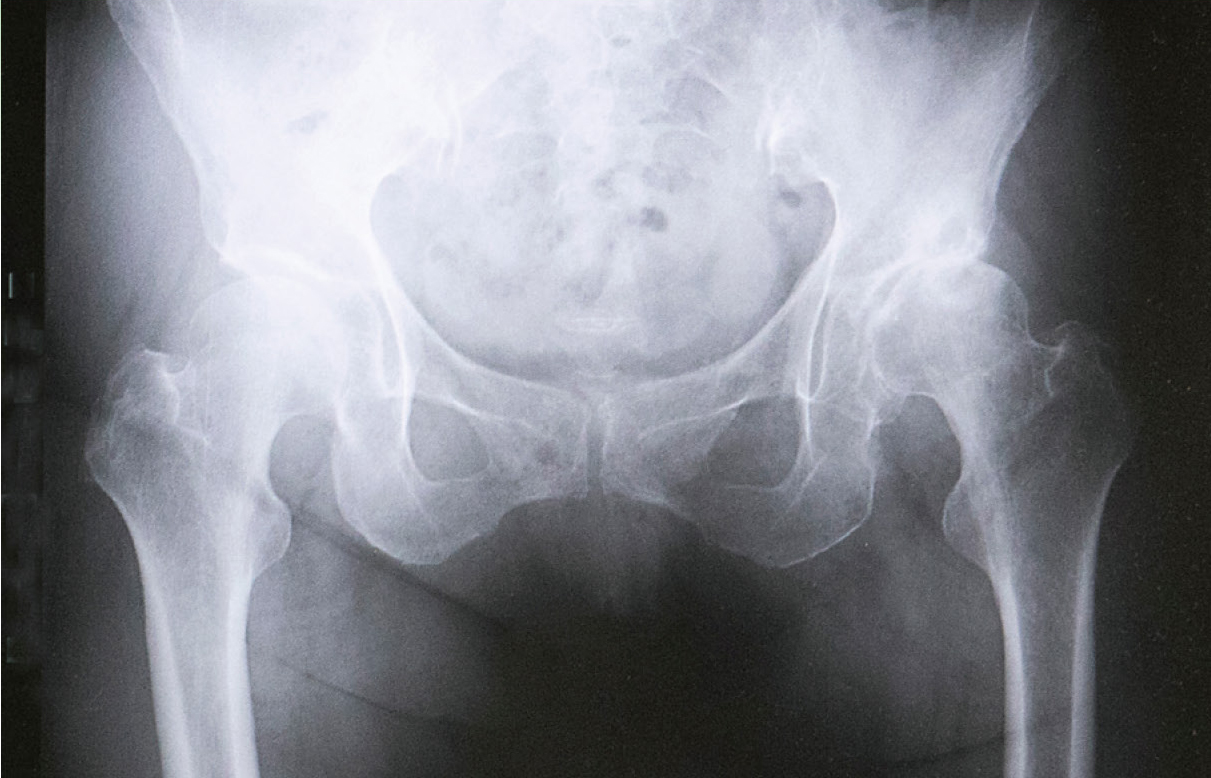 変形性股関節症のレントゲン