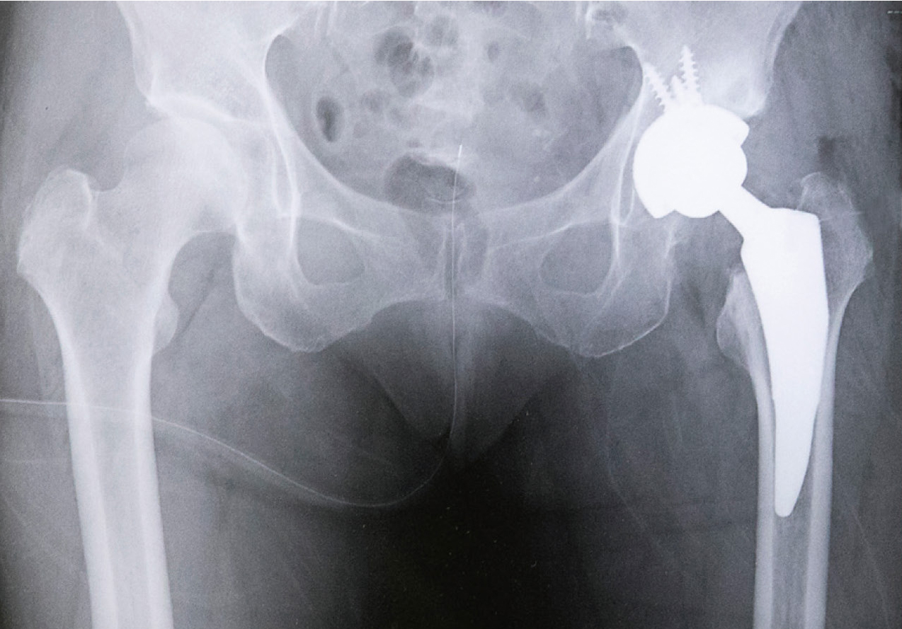 人工股関節置換術後レントゲン
