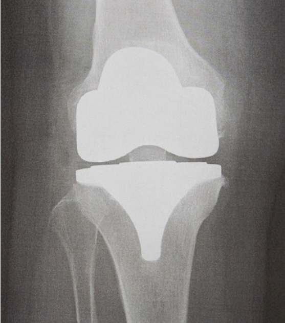 人工膝関節全置換術後のレントゲン