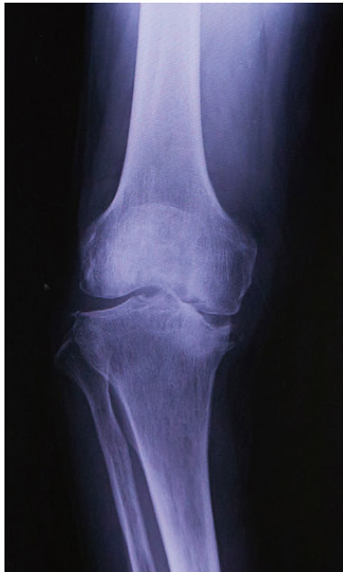 変形性膝関節症のレントゲン