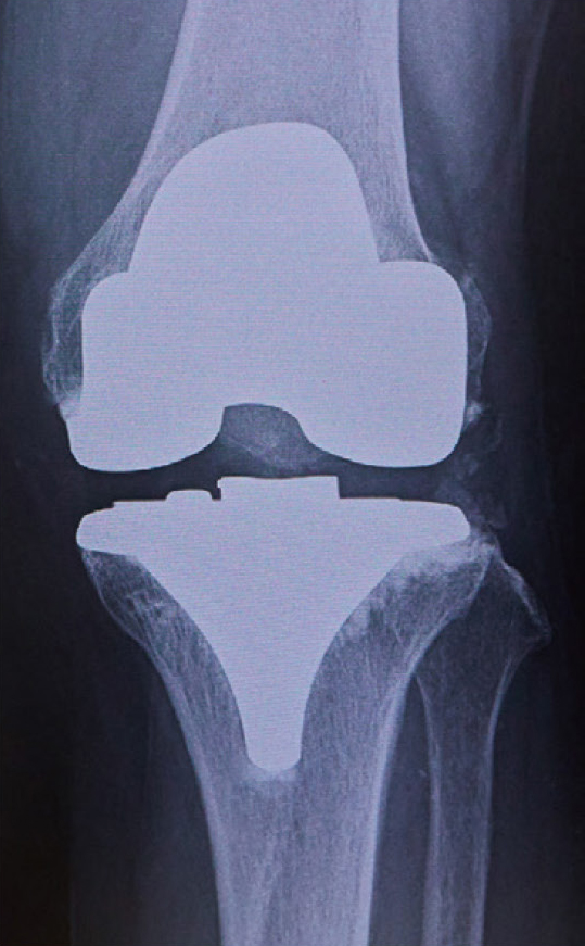 人工関節全側置換術のレントゲン