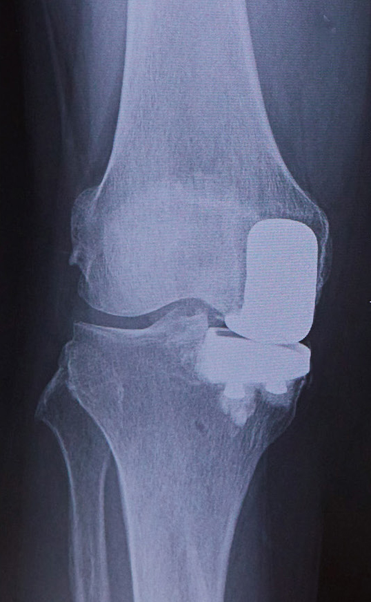 人工関節片側置換術のレントゲン