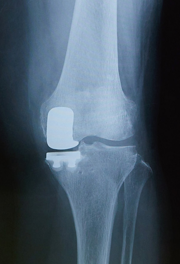 部分置換術後のレントゲン