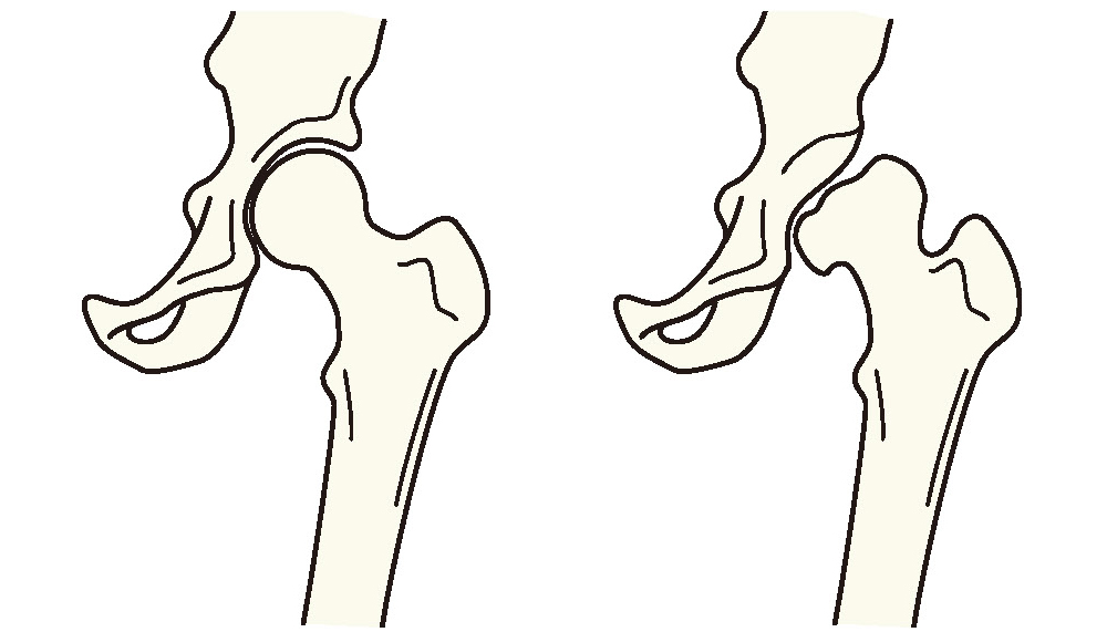 正常な股関節と臼蓋形成不全