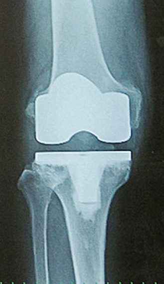 人工膝関節全置換術後のレントゲン
