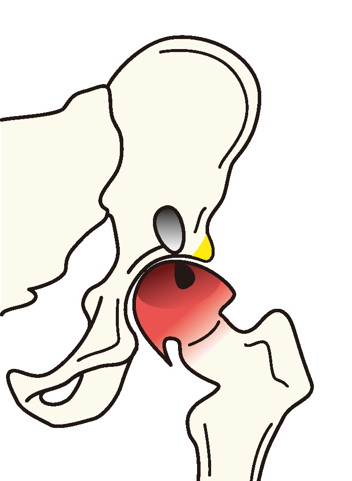 大腿骨頭壊死