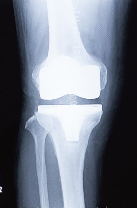 人工膝関節全置換術後のレントゲン