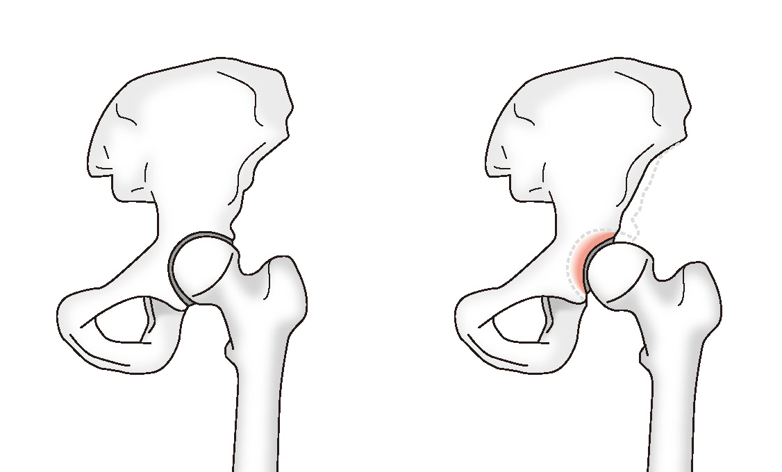 正常な股関節と臼蓋形成不全