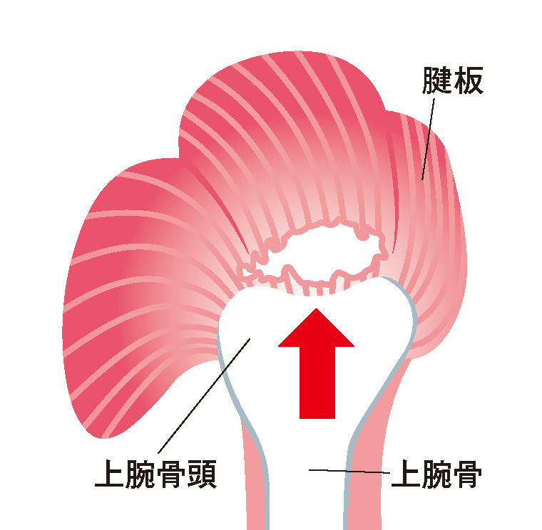 腱板断裂