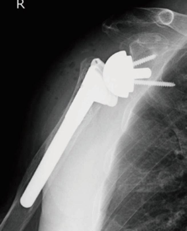 人工肩関節置換術後のレントゲン