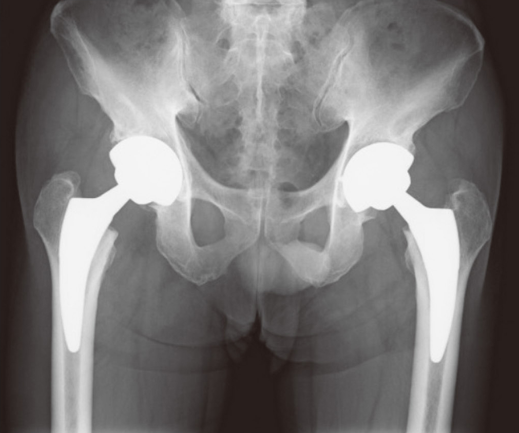 人工股関節置換術後のレントゲン