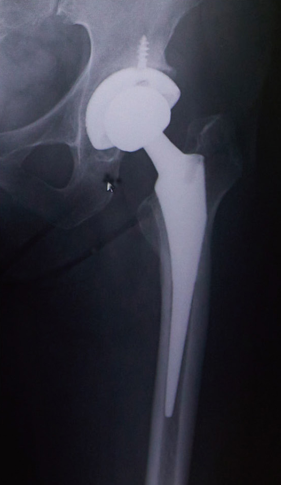 人工股関節置換術後のレントゲン