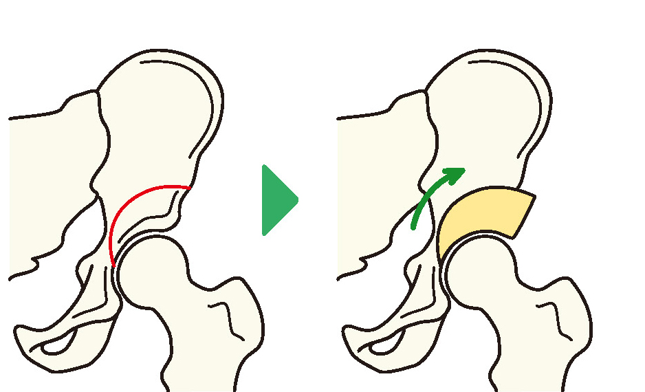 寛骨臼回転骨切り術