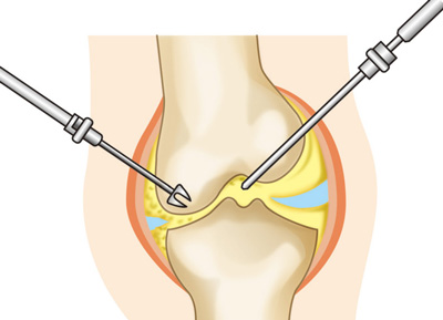 関節鏡手術